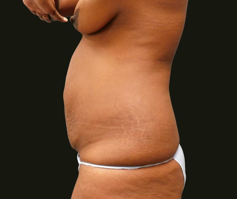 Mommy Makeover Before & After Gallery - Patient 335785 - Image 7