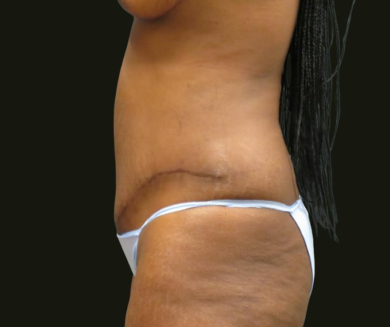 Mommy Makeover Before & After Gallery - Patient 335785 - Image 8