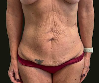 Mommy Makeover Before & After Gallery - Patient 897792 - Image 1