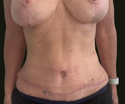Mommy Makeover Before & After Gallery - Patient 897792 - Image 2