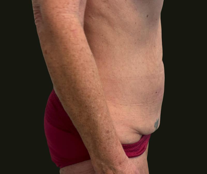 Mommy Makeover Before & After Gallery - Patient 897792 - Image 3