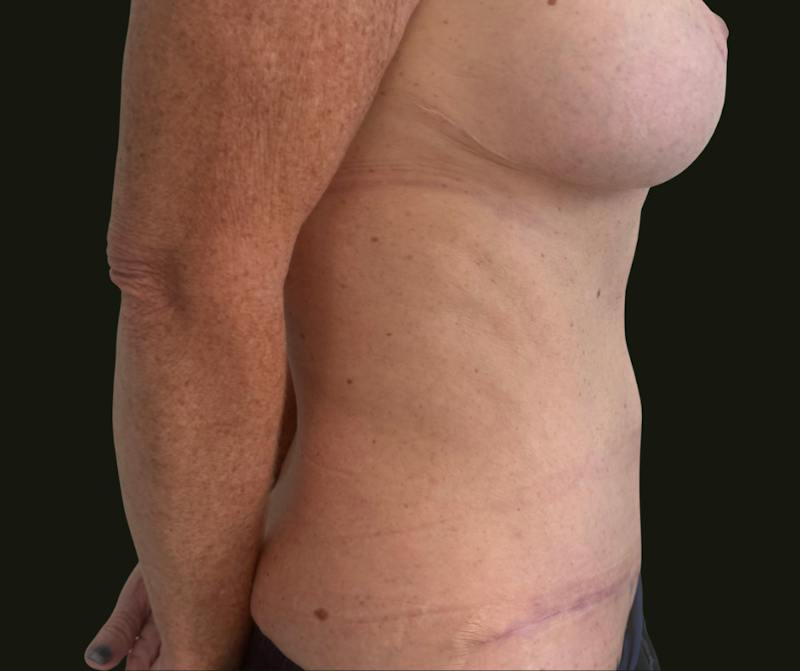 Mommy Makeover Before & After Gallery - Patient 897792 - Image 4