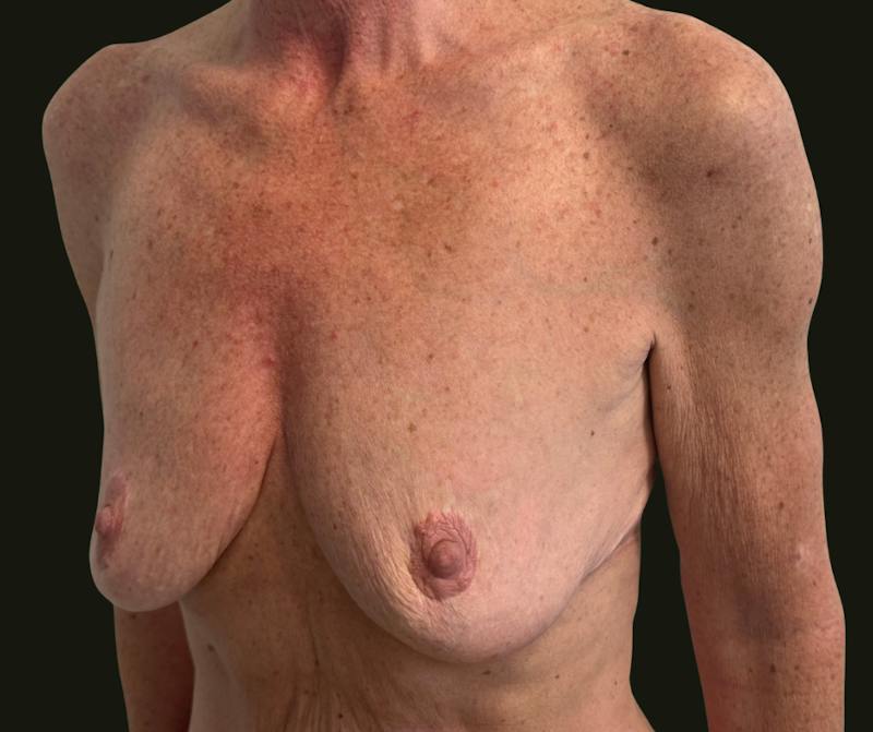Mommy Makeover Before & After Gallery - Patient 897792 - Image 5