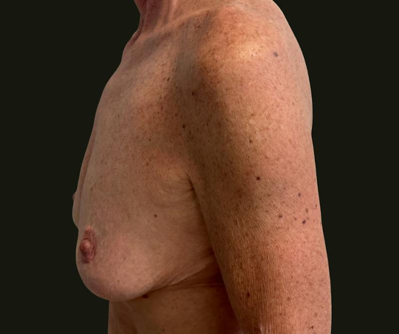 Mommy Makeover Before & After Gallery - Patient 897792 - Image 7