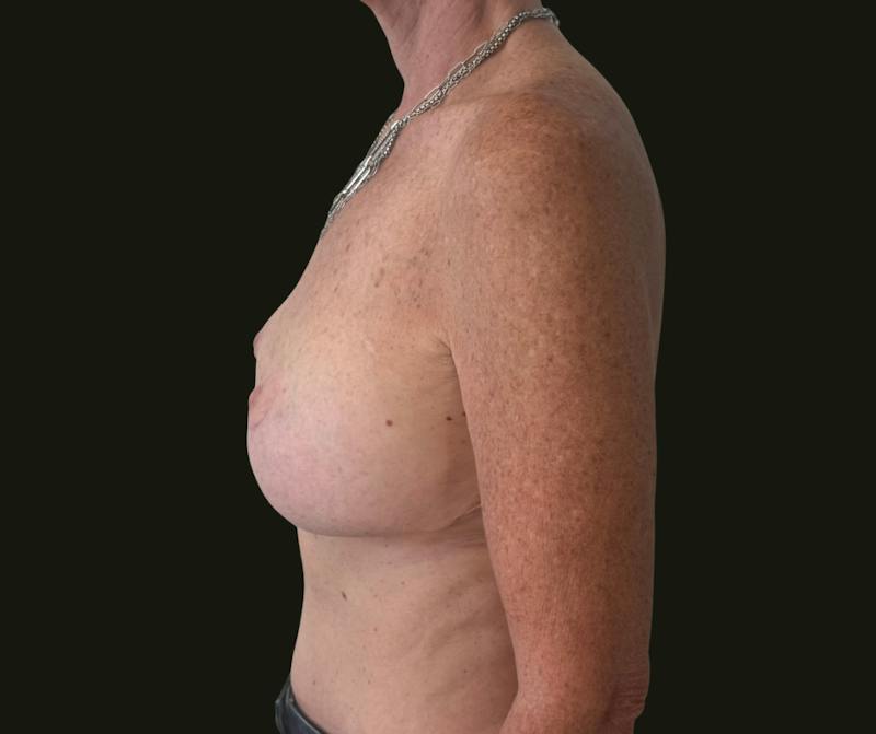 Mommy Makeover Before & After Gallery - Patient 897792 - Image 8
