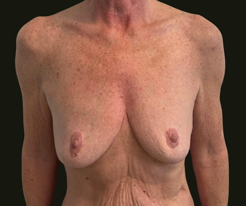 Mommy Makeover Before & After Gallery - Patient 897792 - Image 9