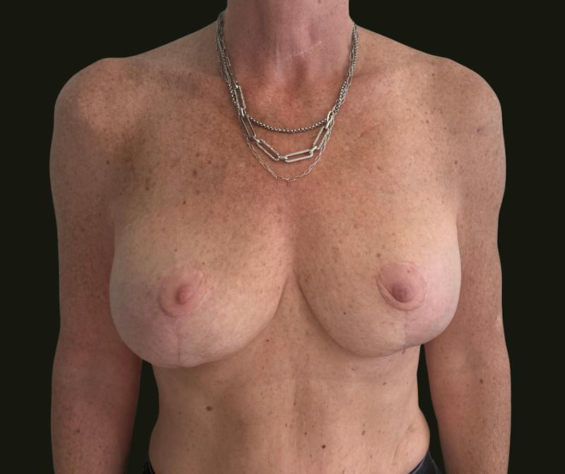 Mommy Makeover Before & After Gallery - Patient 897792 - Image 10