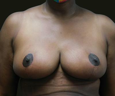 Mommy Makeover Before & After Gallery - Patient 380424 - Image 2