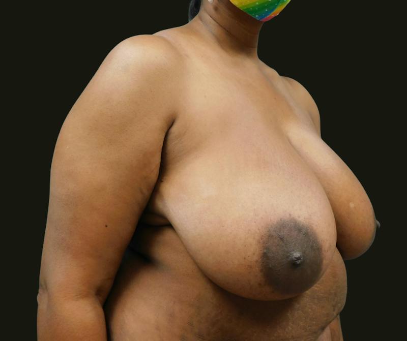 Mommy Makeover Before & After Gallery - Patient 380424 - Image 3