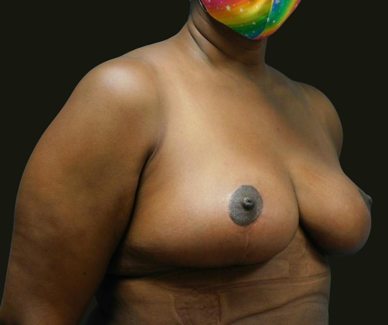 Mommy Makeover Before & After Gallery - Patient 380424 - Image 4