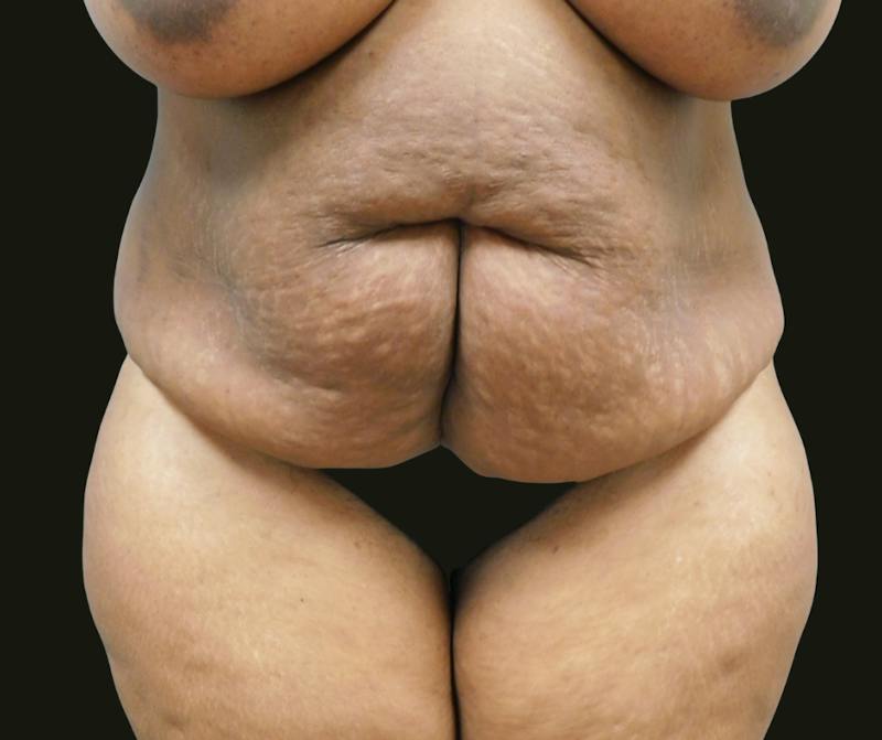 Mommy Makeover Before & After Gallery - Patient 380424 - Image 5