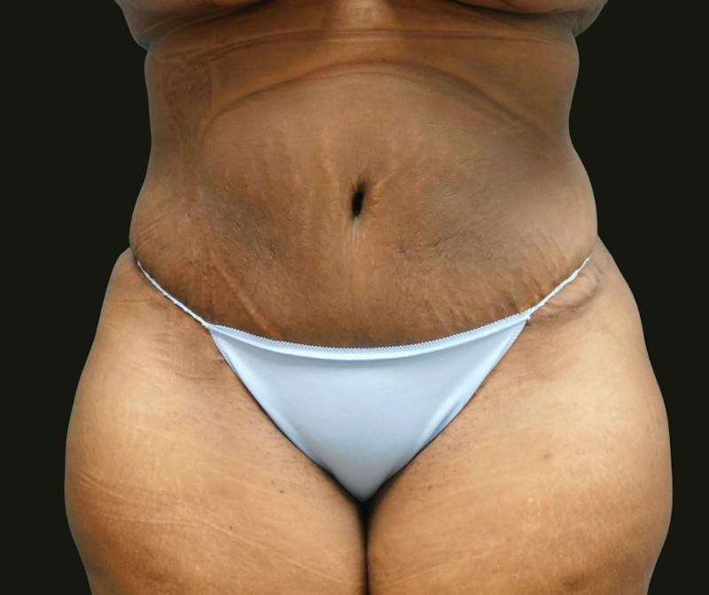 Mommy Makeover Before & After Gallery - Patient 380424 - Image 6