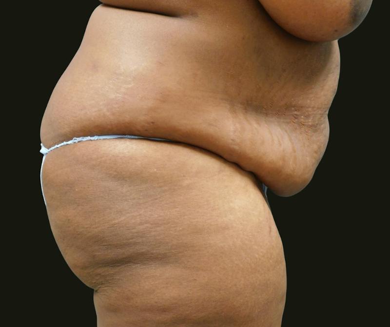 Mommy Makeover Before & After Gallery - Patient 380424 - Image 7