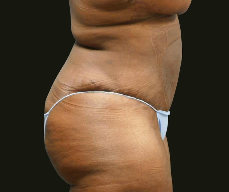 Mommy Makeover Before & After Gallery - Patient 380424 - Image 8