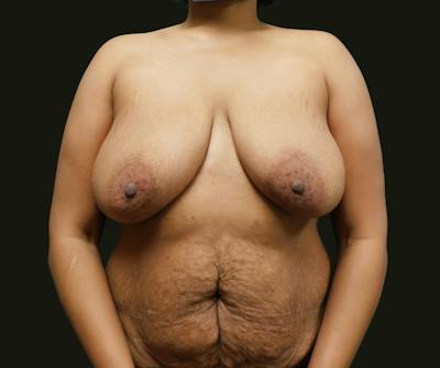 Mommy Makeover Before & After Gallery - Patient 244049 - Image 1