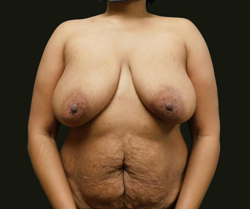 Mommy Makeover Before & After Gallery - Patient 244049 - Image 1
