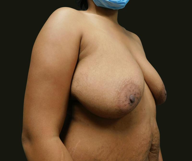 Mommy Makeover Before & After Gallery - Patient 244049 - Image 3
