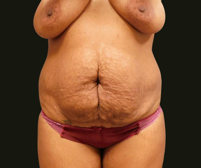 Mommy Makeover Before & After Gallery - Patient 244049 - Image 5