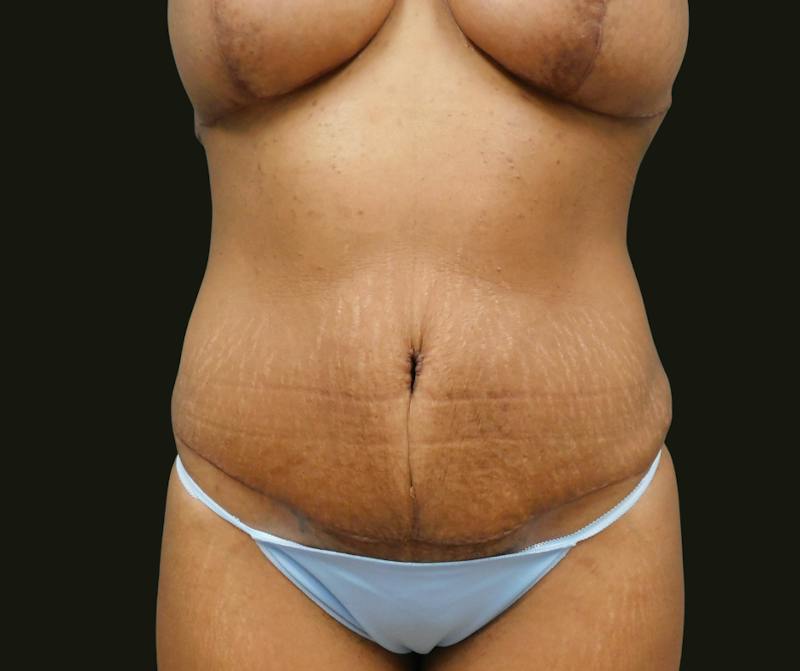 Mommy Makeover Before & After Gallery - Patient 244049 - Image 6