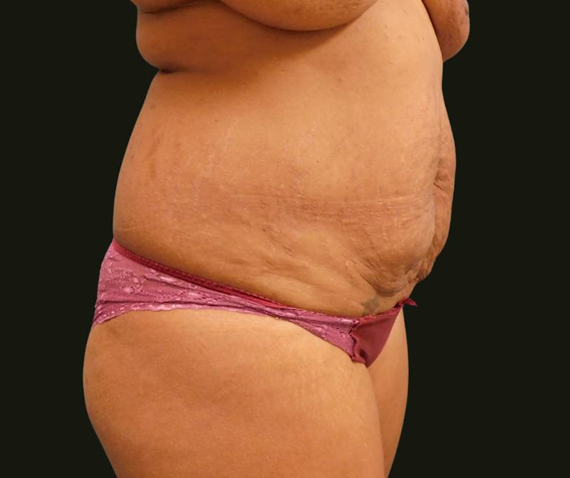 Mommy Makeover Before & After Gallery - Patient 244049 - Image 7