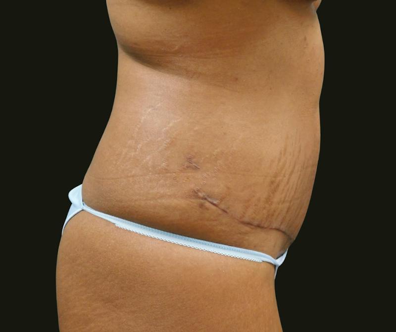 Mommy Makeover Before & After Gallery - Patient 244049 - Image 8