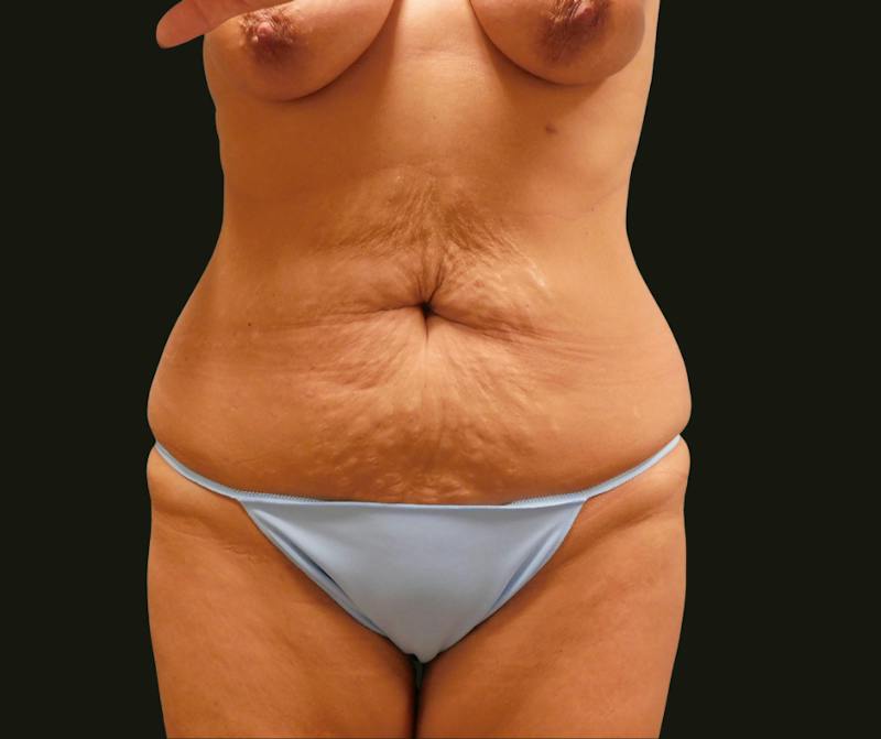 Mommy Makeover Before & After Gallery - Patient 135947 - Image 5