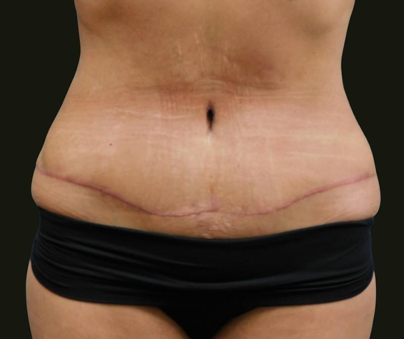 Mommy Makeover Before & After Gallery - Patient 135947 - Image 6