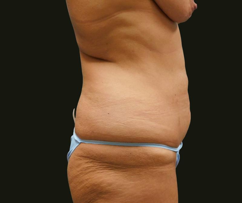 Mommy Makeover Before & After Gallery - Patient 135947 - Image 7