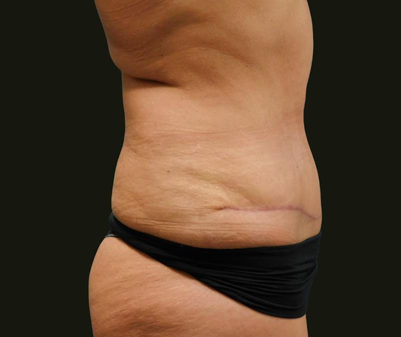 Mommy Makeover Before & After Gallery - Patient 135947 - Image 8