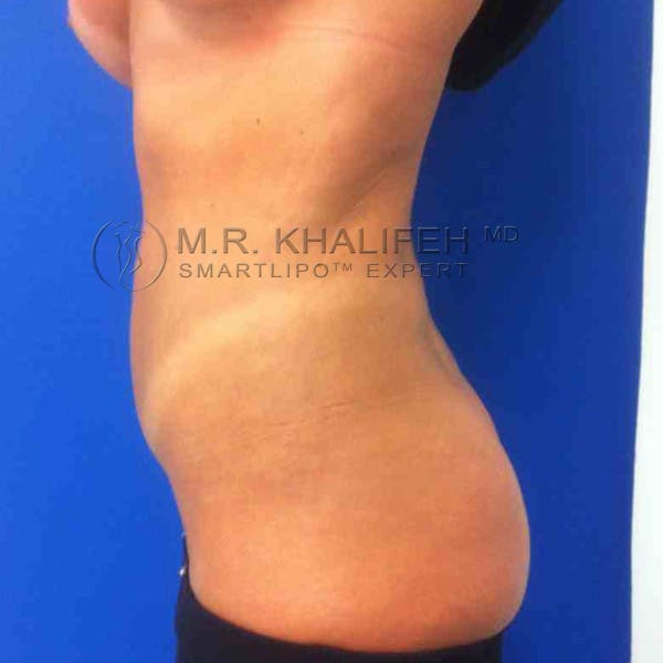 Abdominal Liposuction Gallery - Patient 3717613 - Image 4