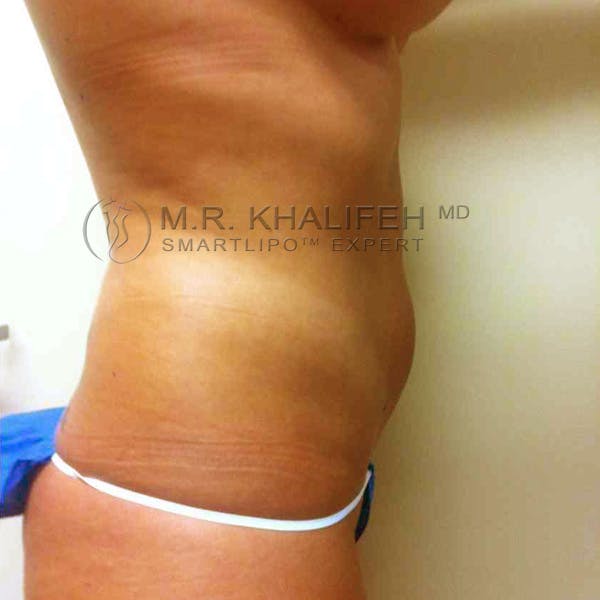 Abdominal Liposuction Gallery - Patient 3717613 - Image 5