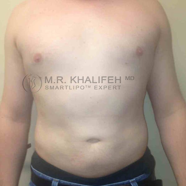 Abdominal Liposuction Gallery - Patient 3717634 - Image 4