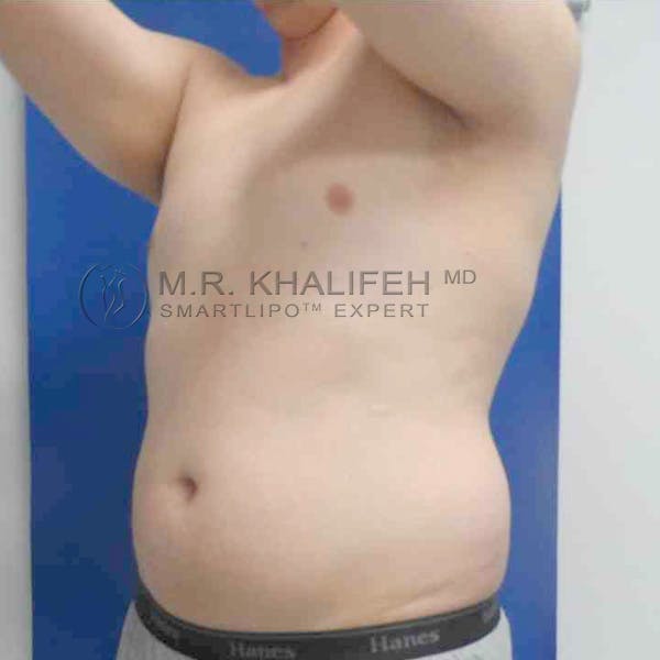 Abdominal Liposuction Gallery - Patient 3717634 - Image 5