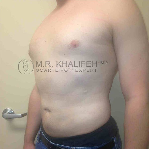 Abdominal Liposuction Gallery - Patient 3717634 - Image 6