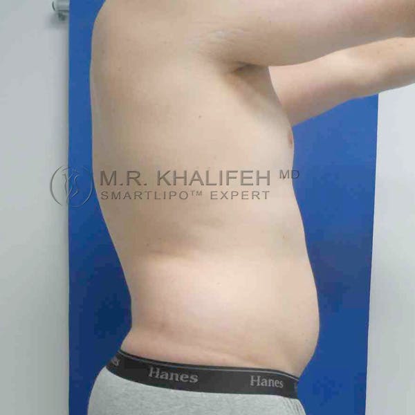 Abdominal Liposuction Gallery - Patient 3717634 - Image 9