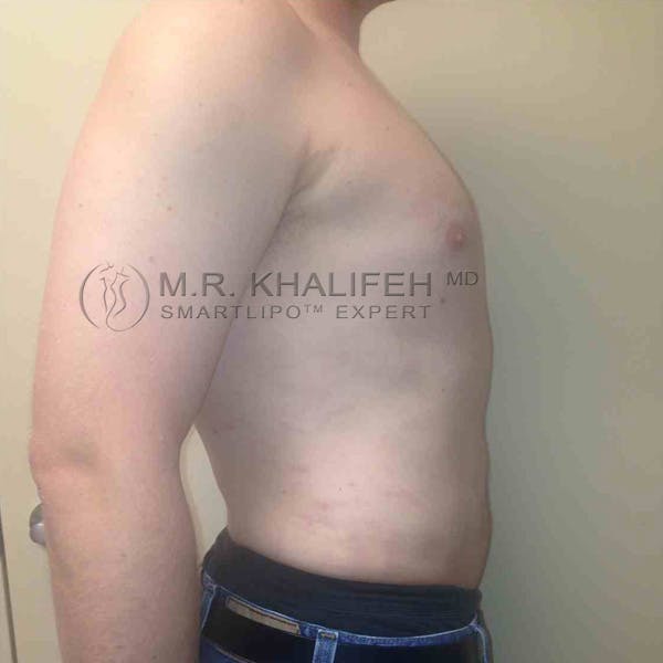 Abdominal Liposuction Gallery - Patient 3717634 - Image 10