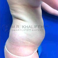 Abdominal Liposuction Gallery - Patient 3717635 - Image 1