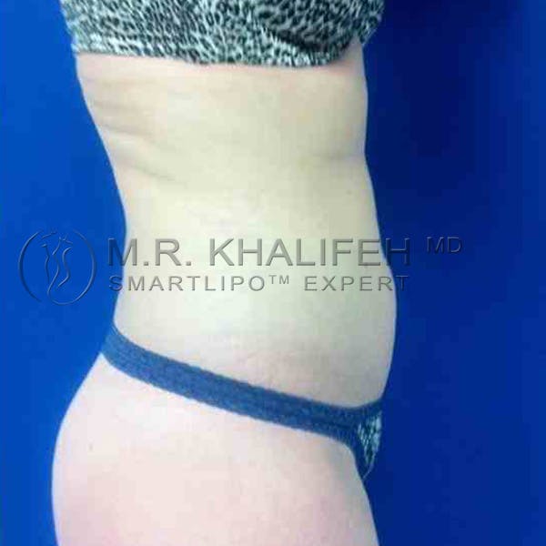 Abdominal Liposuction Gallery - Patient 3717635 - Image 2
