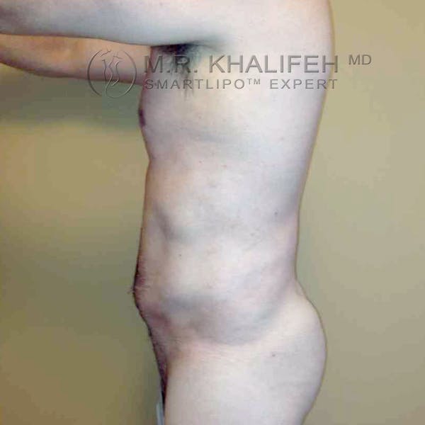 Abdominal Liposuction Gallery - Patient 3717637 - Image 8