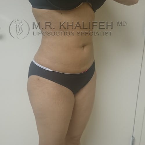 Abdominal Liposuction Gallery - Patient 3717638 - Image 4