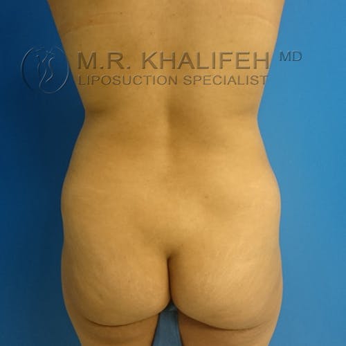 Abdominal Liposuction Gallery - Patient 3717638 - Image 9