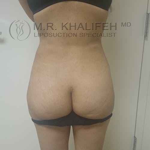 Abdominal Liposuction Gallery - Patient 3717638 - Image 10