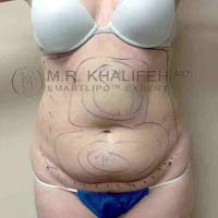 Abdominal Liposuction Gallery - Patient 3717639 - Image 1