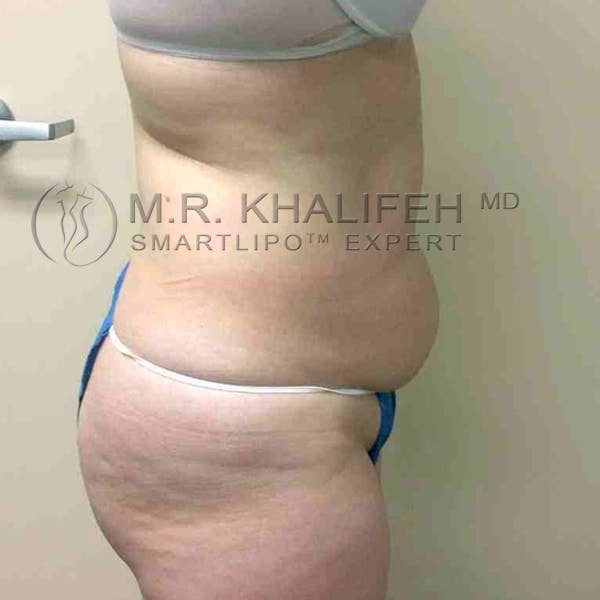 Abdominal Liposuction Gallery - Patient 3717639 - Image 3