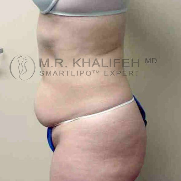 Abdominal Liposuction Gallery - Patient 3717639 - Image 5