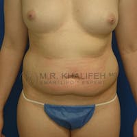 Abdominal Liposuction Gallery - Patient 3717640 - Image 1