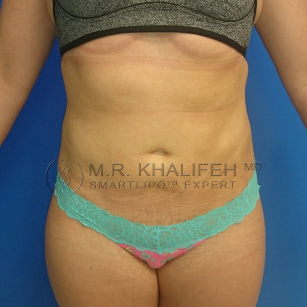 Abdominal Liposuction Gallery - Patient 3717640 - Image 2
