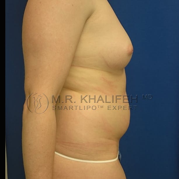 Abdominal Liposuction Gallery - Patient 3717640 - Image 5