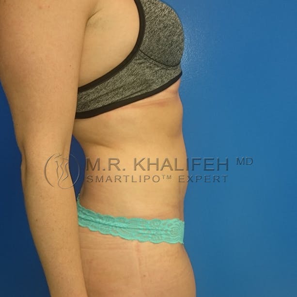 Abdominal Liposuction Gallery - Patient 3717640 - Image 6