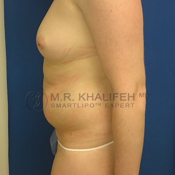 Abdominal Liposuction Gallery - Patient 3717640 - Image 9